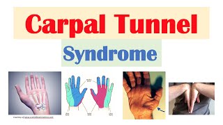 Carpal Tunnel Syndrome | Risk Factors, Pathogenesis, Signs & Symptoms, Diagnosis, Treatment