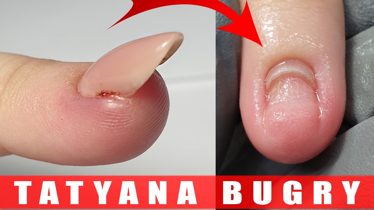 Nail bed injury Pictures types and treatments