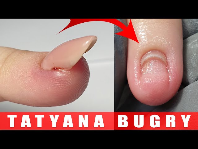 How to drain blood from under a nail | Cigna
