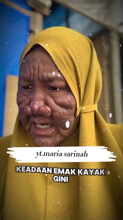 ibu ini sangat sedih karena malu dgn fisiknya 😢 #ys #sad #youtubeshorts #shorts