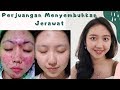 PERJUANGAN Menyembuhkan JERAWAT -  My Acne Journey