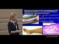 07 Поражение кожи при HCV-ассоциированном криоглобулинемическом васкулите