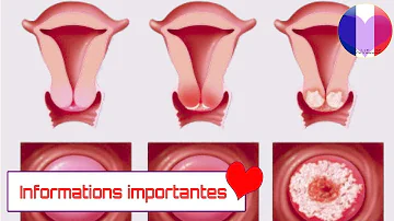 Quels sont les stades du cancer de l'utérus ?