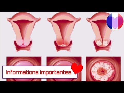 Vidéo: Connaissances, Attitudes Et Pratiques Des Femmes (CAP) Concernant Les Cancers Du Sein Et Du Col De L'utérus Dans Les Zones Rurales Du Zimbabwe: Une étude Transversale Dans Le