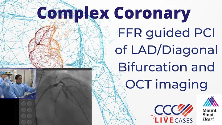 FFR guided PCI of LAD/Diagonal Bifurcation and OCT imaging - CCC Live April 2016