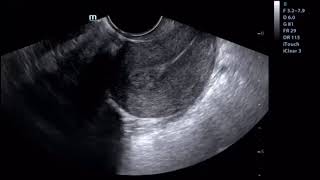 Dr. Yavuz Şimşek- Tüp Bebek Merkezi-Polipler embriyo implantasyonunu bozuyor.