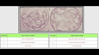 IVF: Embryo Grading - AB, and BB