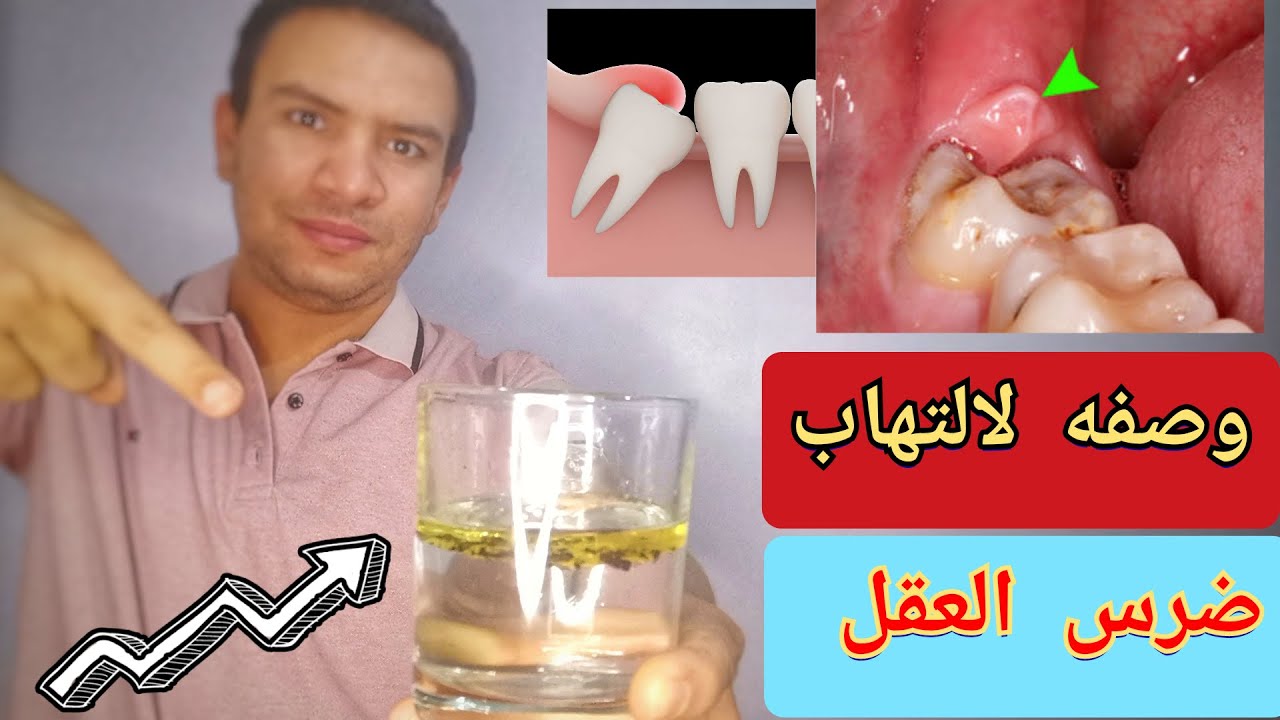 كيف تعالج التهاب ضرس العقل الشديد بنفسك بدون طبيب