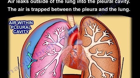 Tension Pneumothorax - Everything You Need To Know - Dr. Nabil Ebraheim