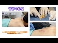背部の粉瘤　ブログでも粉瘤について詳しく解説してます。東京皮膚のできものと粉瘤クリニック　ふるばやし形成外科新宿院　大阪梅田形成外科クリニック
