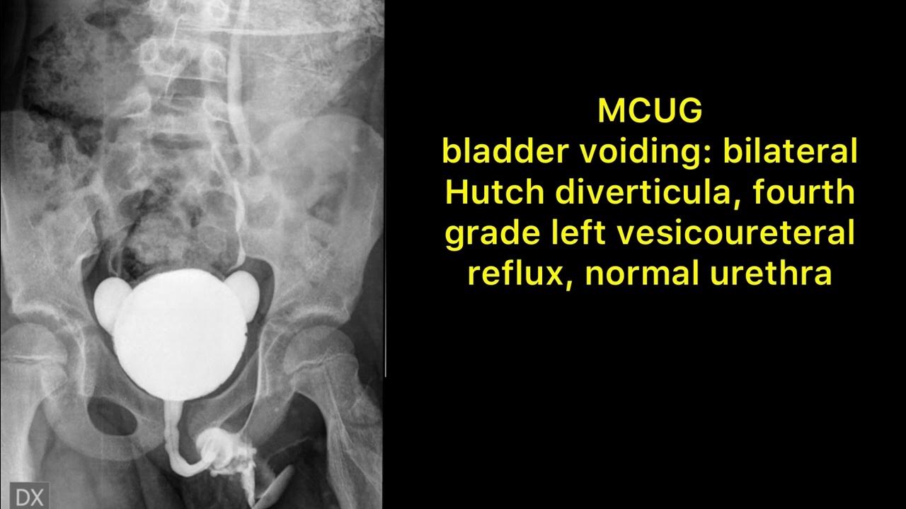 HUTCH DIVERTICULUM ON EACH MODALITY YouTube