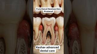 advanced decay# hemisection #consult #8836577398
