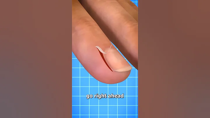 Why You shouldn't Peel Your Hangnails 😣 #shorts #viralshorts