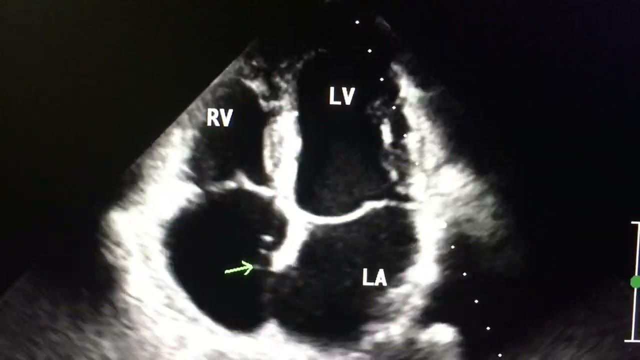 Chiari Network: How to Distinguish It from a Clot