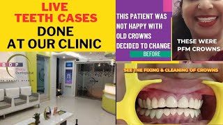BIG SMILE TRANSFORMATION,PATIENT WAS NOT HAPPY WITH HER OLD PFM CROWNS