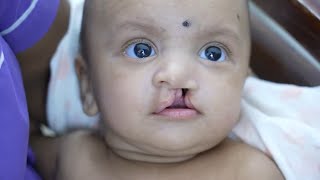 Before and After Cleft lip Surgery Baby - Amazing Surgery Results & Journey