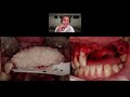 Vertical defects with hard and soft tissue augmentation in anterior region