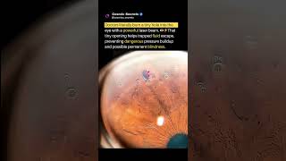Doctors Burn Tiny Holes Into The Eye 😳👁️ #short #viral #trending #viralvideo #space #nasa #universe