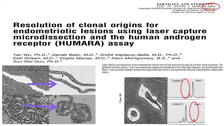 Endometriosis, cancer driver mutations and malignant transformation