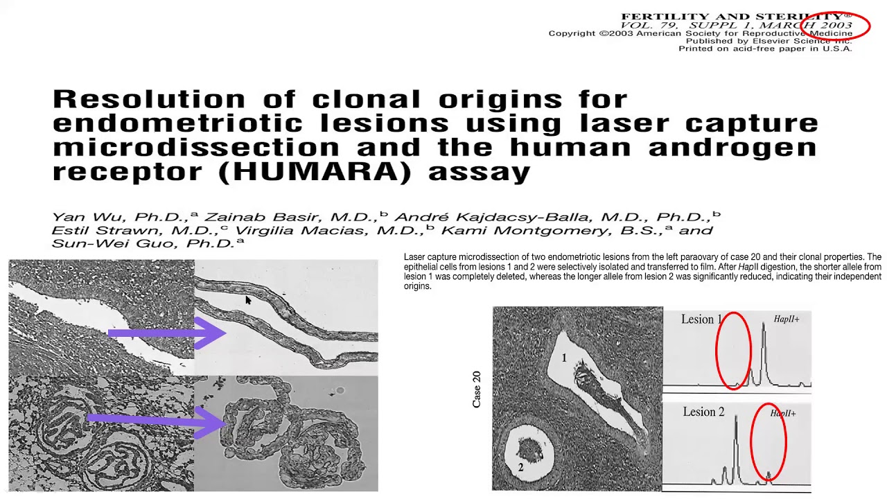“Endometriosis, cancer driver mutations and malignant transformation”
