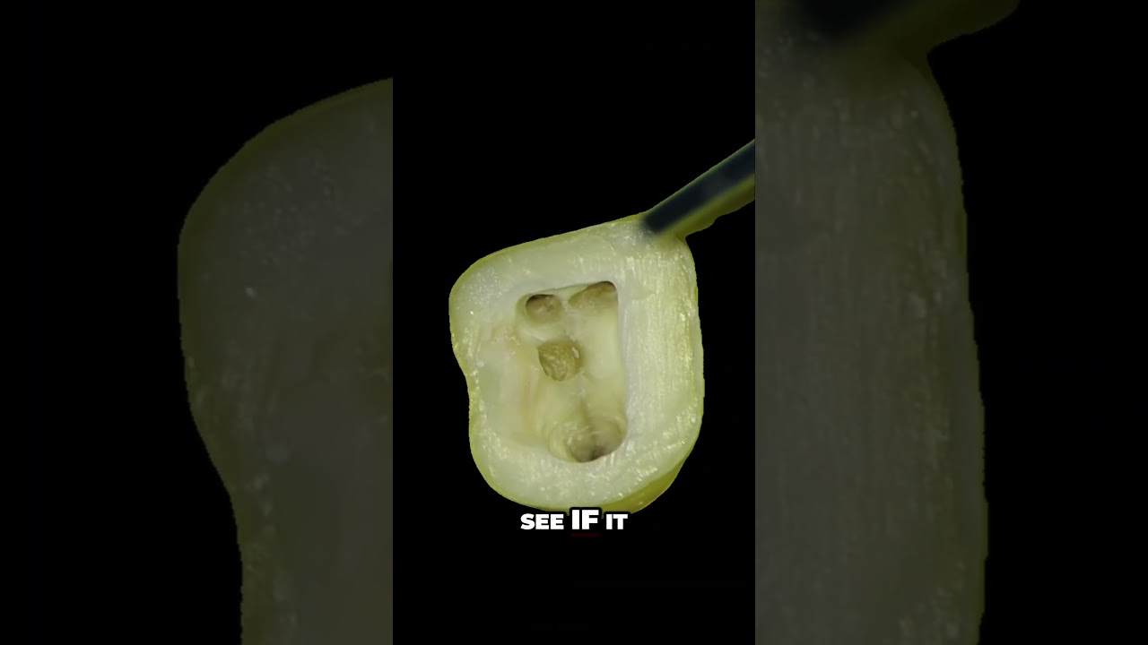 Biodentin  Cavity Repair Demo 🕳️🦷