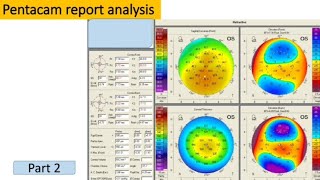 Pentacam Report Analysis
