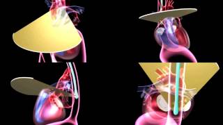 Four view animation of TEE probe