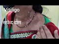 Safed Daag Lecoderma Pura Thik Hua Hai.8867239831