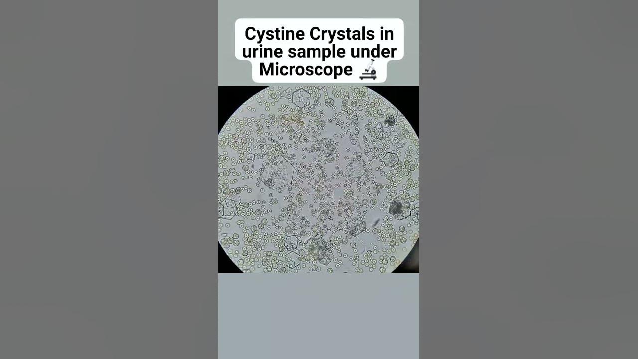 Cystine Crystals in urine sample under Microscope. YouTube