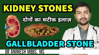 kidney stones vs gallbladder stone  कब कोन सी दवा लें और कब surgery कराएं Dr Animesh MS