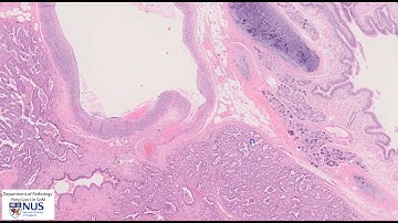 Lung adenocarcinoma microscopy - Talking slide