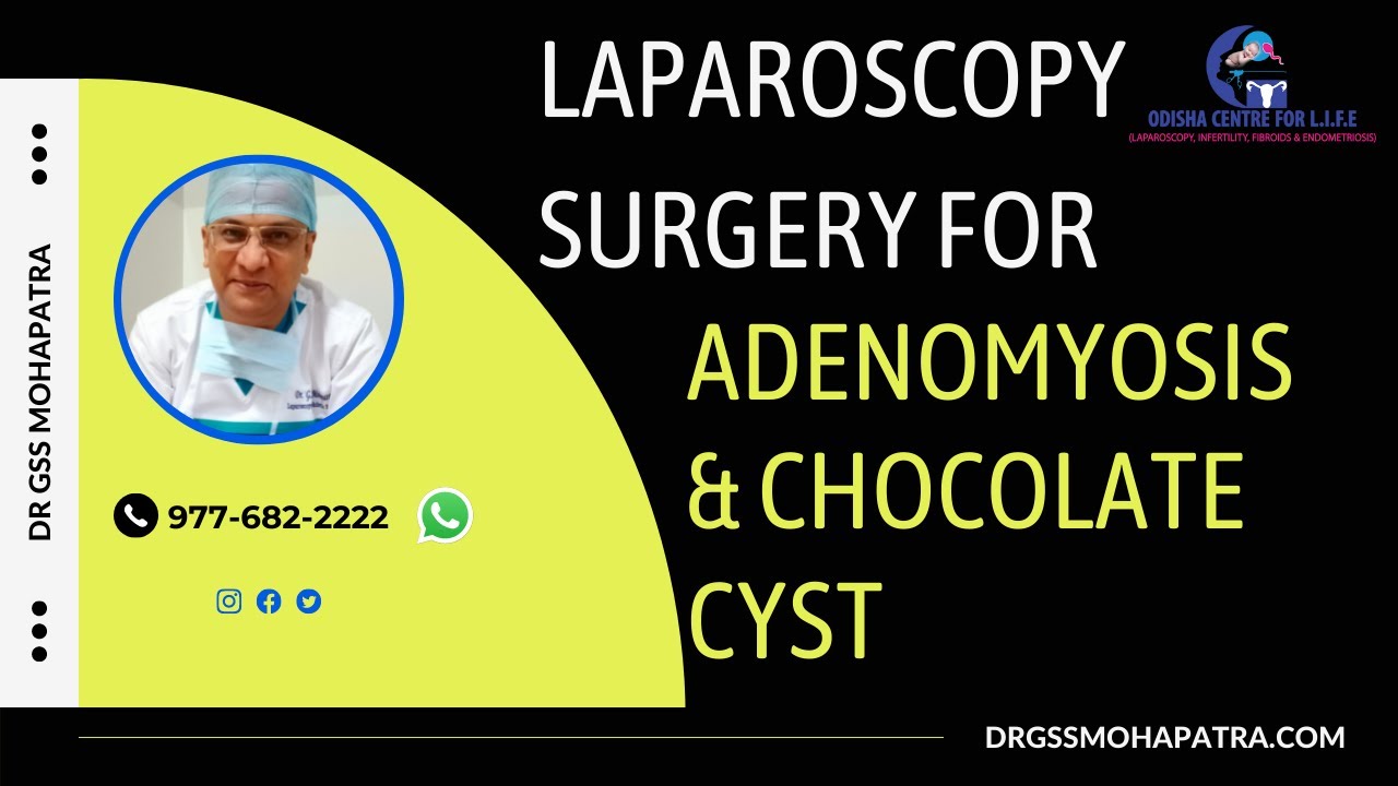 LAPAROSCOPY SURGERY FOR ADENOMYOSIS & CHOCOLATE CYST BY ENDOMETRIOSIS