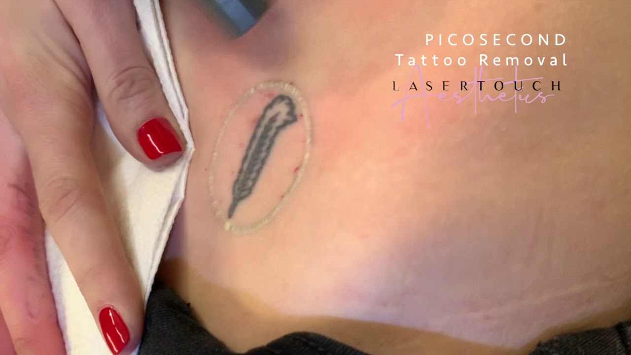 Picosecond Tattoo Removal at Laser Touch Aesthetics NYC