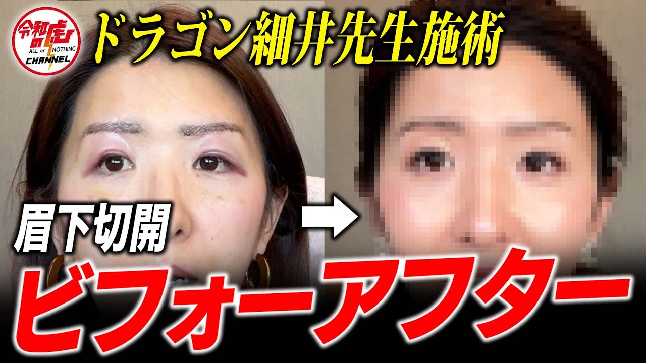 【眉下切開】アマソラクリニック美容整形後のダウンタイム経過をお見せします。