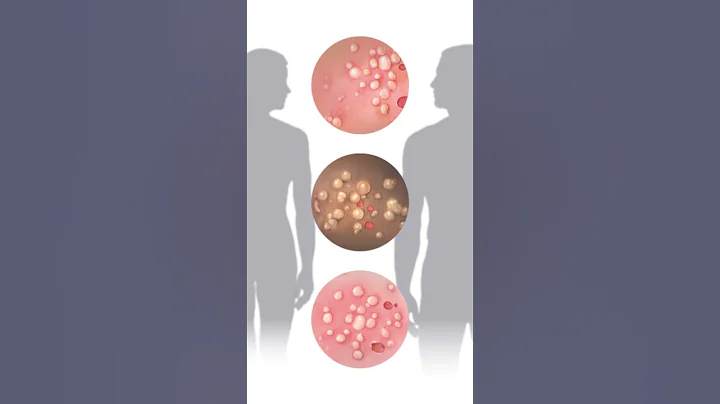 3 Warning Signs of Genital Herpes - DayDayNews