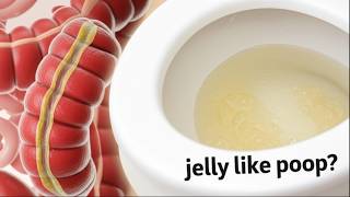 Why Do I Pass Jelly-Like Mucus from My Anus? Causes, Symptoms & When to Seek Help