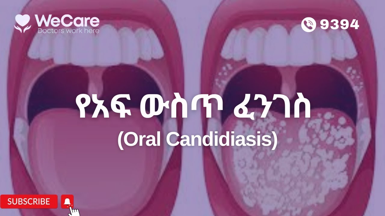 የአፍ ውስጥ ፈንገስ (Oral Candidiasis)