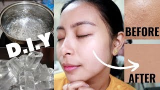 DIY! Yelo at Pinakulong Tubig EFFECTIVE for large PORES and PIMPLES!