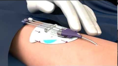 3M™ PICC / CVC Securement System Application and Removal | 3M Critical & Chronic Care Solutions
