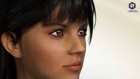 Niềng răng có phải nhổ răng không? Trường hợp nào phải nhổ răng?