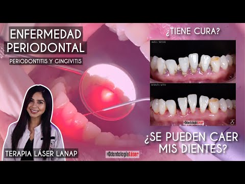 Enfermedad Periodontal, ¿Tiene cura? ¿Se pueden caer mis dientes? Terapia Lanap - Odontología Láser.