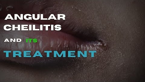 What is Angular Cheilitis? Causes, Symptoms, and Treatment.