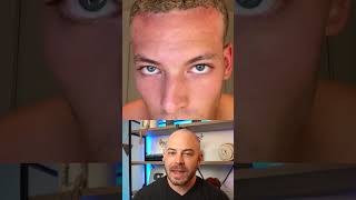 Doctor reacts to dermarolling routine for hair growth! #hairloss #dermreacts #doctorreacts