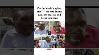 His Rare Condition Gradually Turns Tissue Into Bone 😲#truestory#shorts#fyp