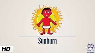 Sunburn, Causes, Signs and Symptoms, Diagnosis and Treatment.