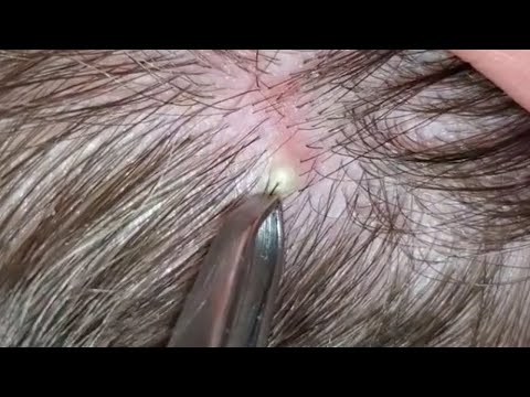 The Most Satisfying Ingrown Hair - Pulling Juicy Hair Part 50