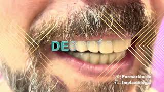 IMPLANTES DENTALES DR ISMAEL SORIANO - FORMACION EN IMPLANTOLOGÍA - IMPLANTES DENTALES MADRID