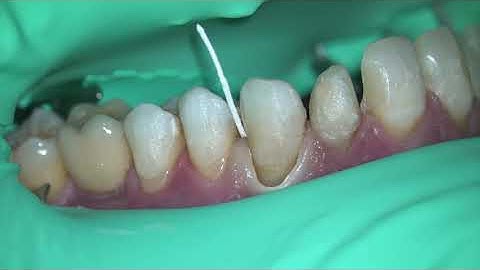 IDS (Immediate Dentin Sealing)