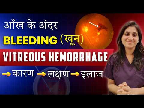 Vitreous Hemorrhage (Eye Bleeding) – Why It Happens & How It’s Treated