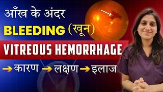 Vitreous Hemorrhage (Eye Bleeding) – Why It Happens & How It’s Treated